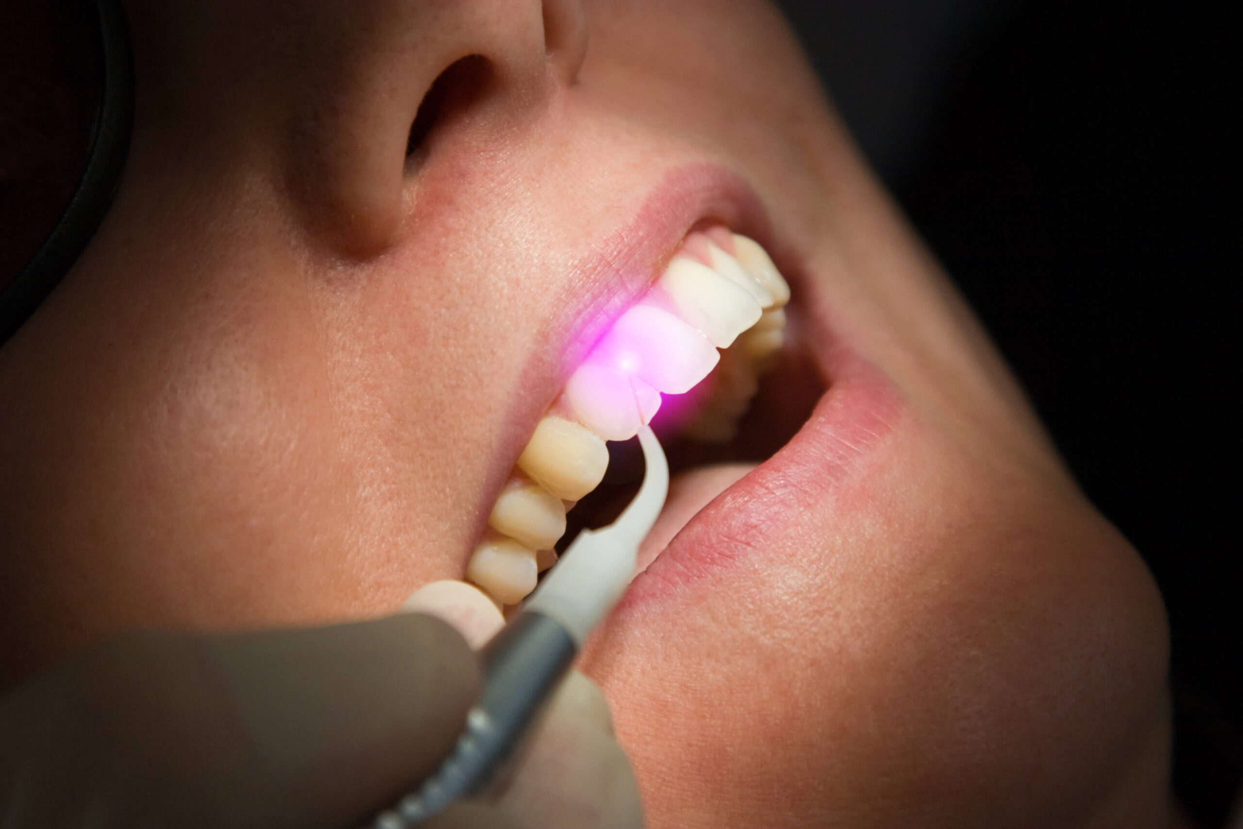 Dental Laser